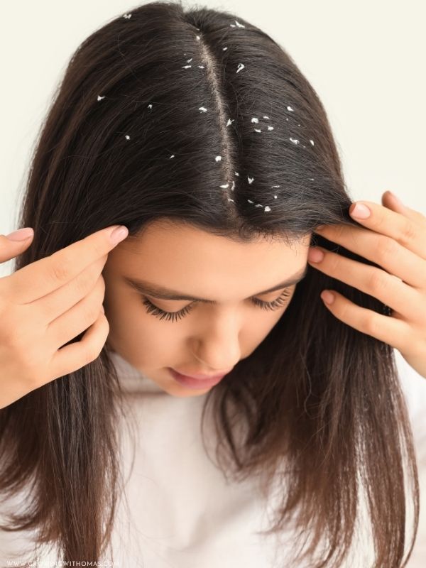 Close-up-of-a-scalp-with-visible-dandruff-flakes