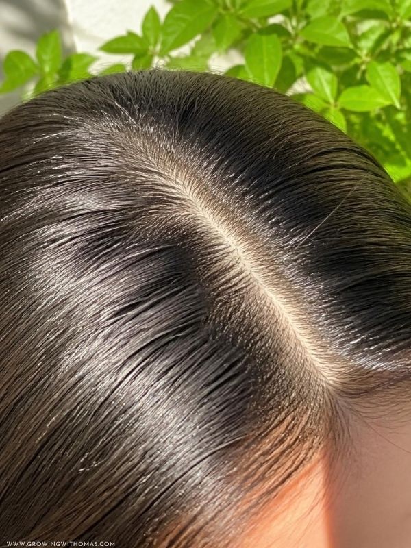 Healthy-clean-scalp-after-consistent-treatment